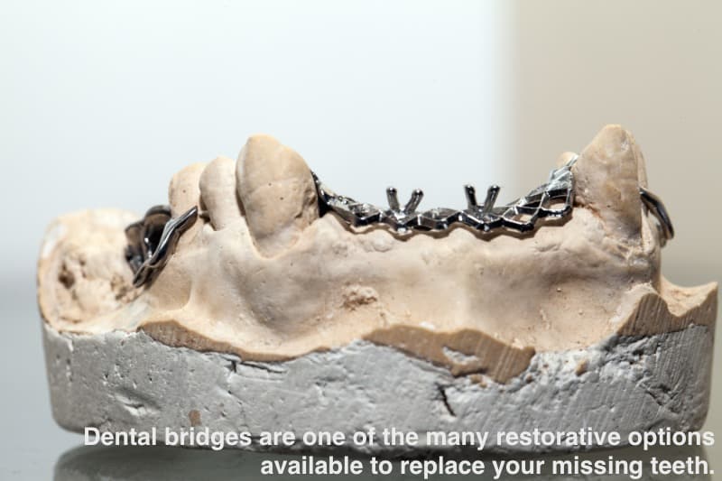 model of human jaw showing missing teeth with gaps filled by dental bridges, with text: "dental bridges are one of the many restorative options available to replace your missing teeth."