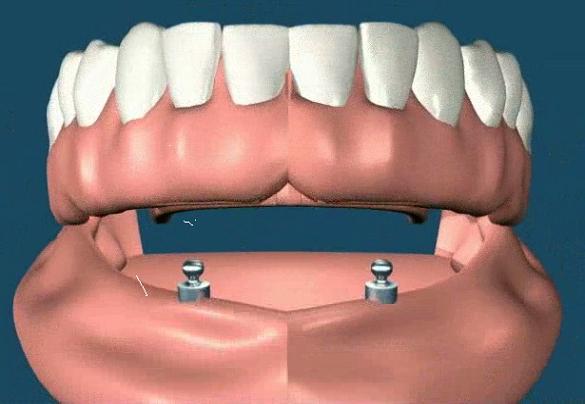graphic of denture being placed over implanted screws