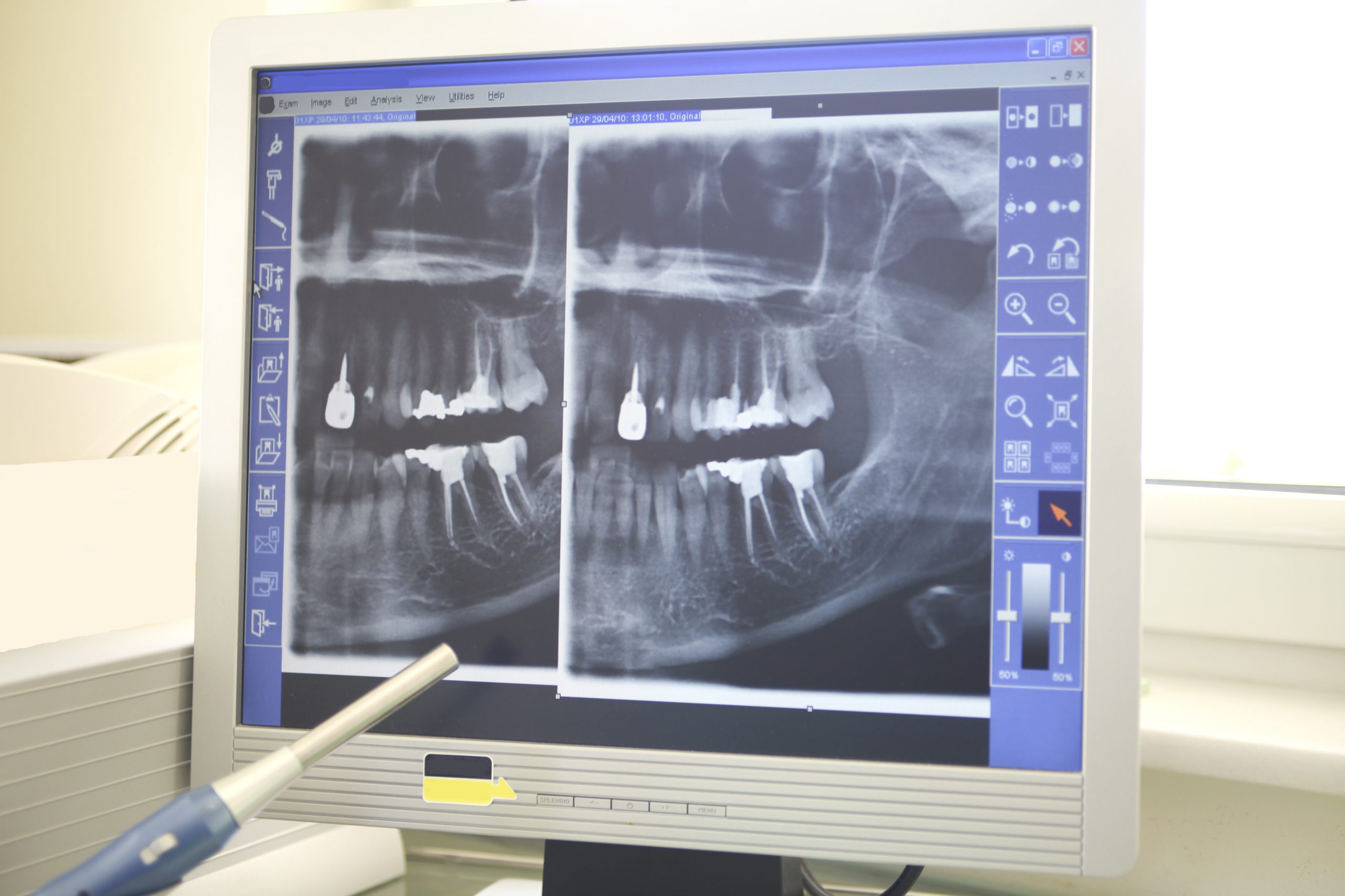 x-ray of patient's mouth
