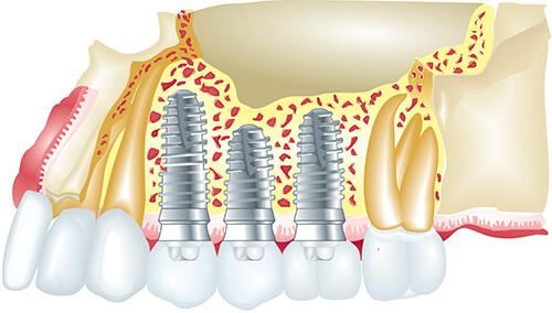 graphic showing cutaway of teeth, with three teeth being implants in jaw