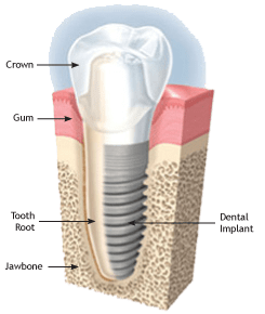 graphic of dental implant showing the parts of the implant