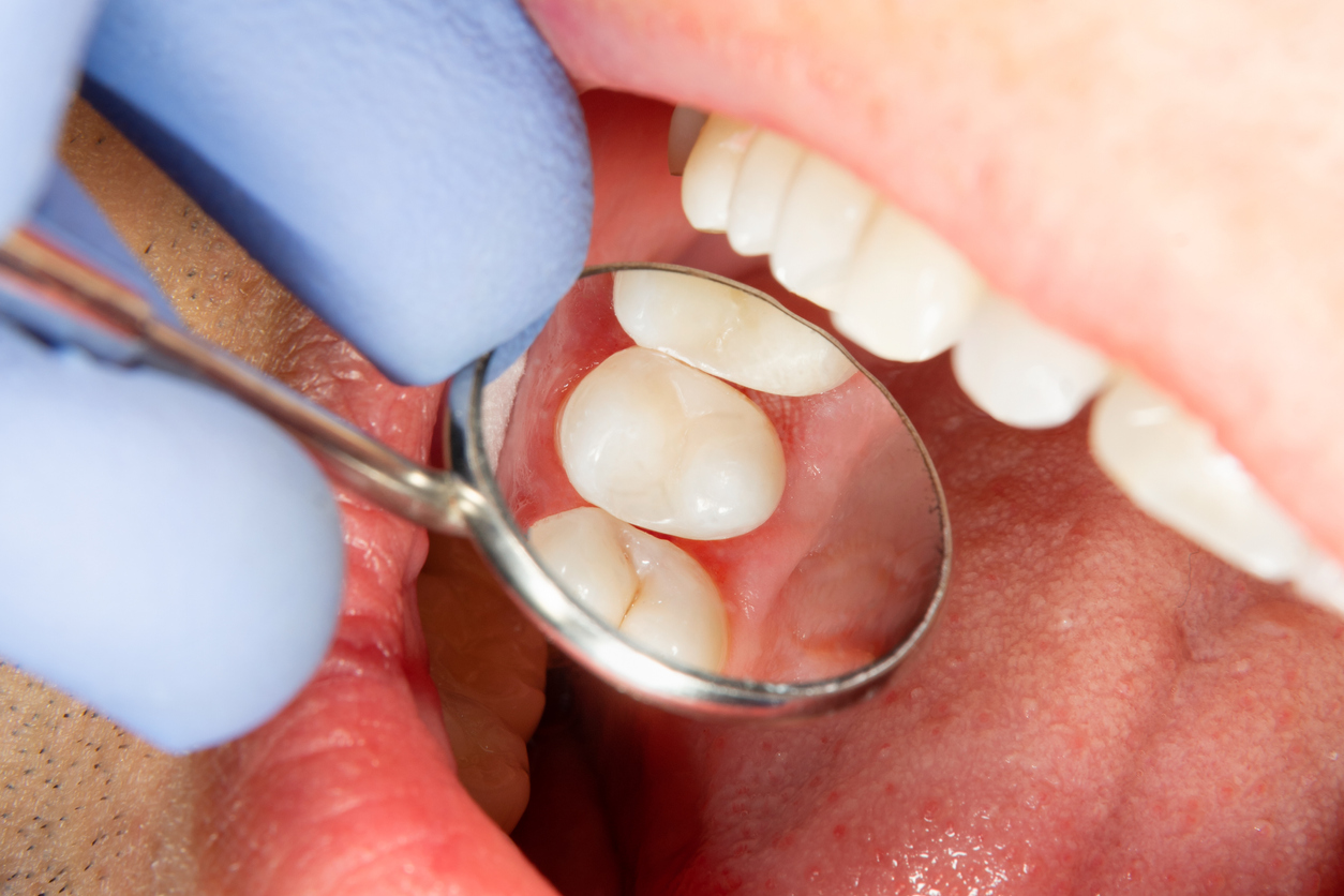 How Long Do Dental Sealants Last?