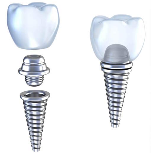 dental implants graphic