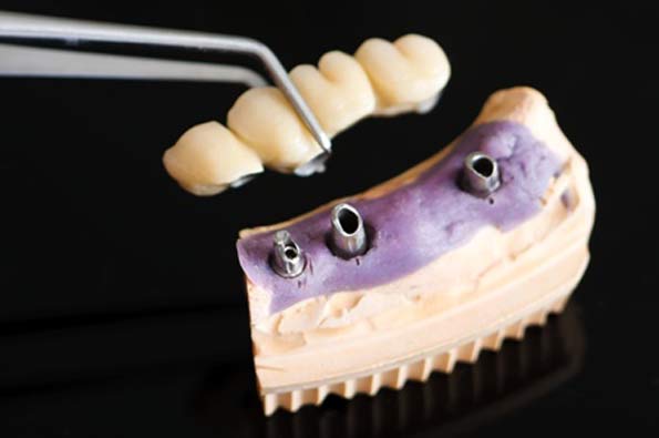 Dental Marfil - 🔹️PUENTES FIJOS DE PORCELANA🔹️ Son los más esteticos  porque se asemejan a sus dientes naturales. Este tipo de puente consiste a  dos coronas que se sostienen de sus dientes