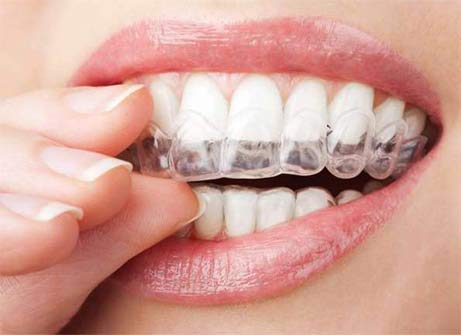 woman fitting invisalign tray to upper teeth