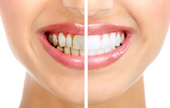 smiling patient cross-section, left side shows teeth before treatment, right side shows white teeth after treatment