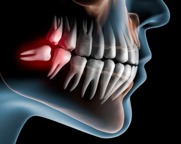 x-ray cutaway of patient's mouth, with wisdom tooth growing in at an angle, tooth highlighted red, to show pain