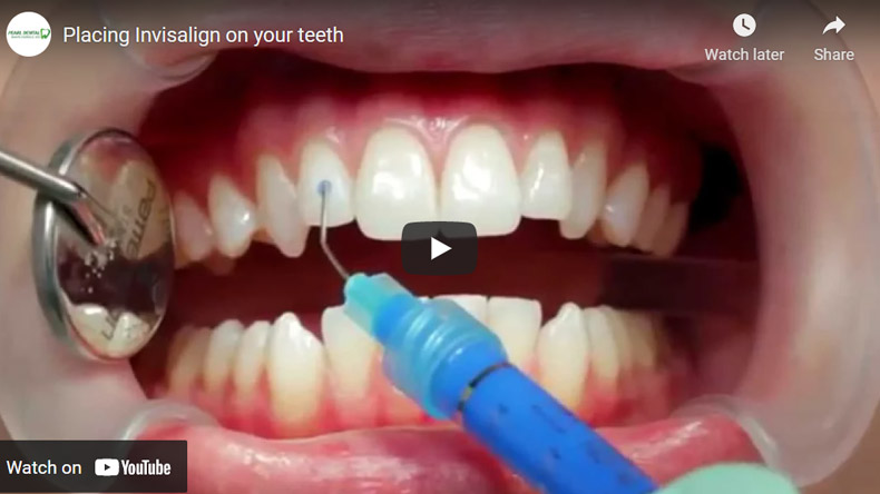 Image of Placing Invisalign on your teeth Click to see Video
