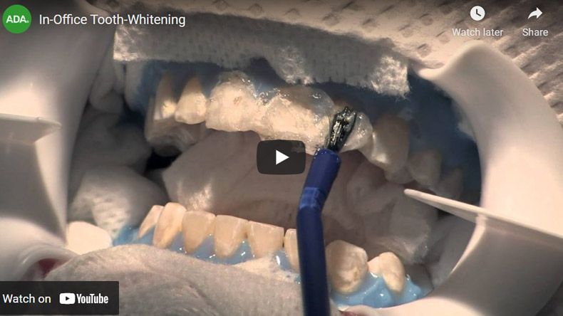 Image of In Office Tooth Whitening Click to see Video