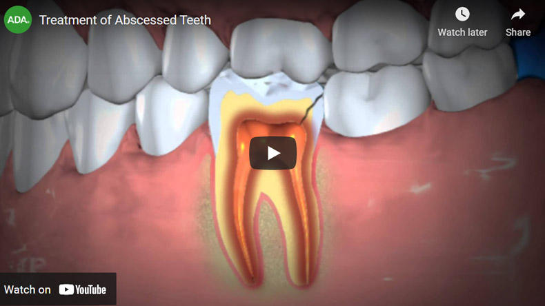 Image of Treatment of Abscessed Teeth Click to See Video