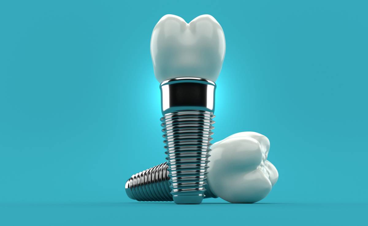 Concept image of dental implants