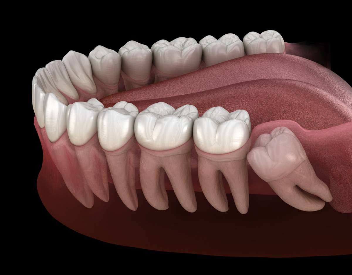 concept image of wisdom teeth that will cause infection