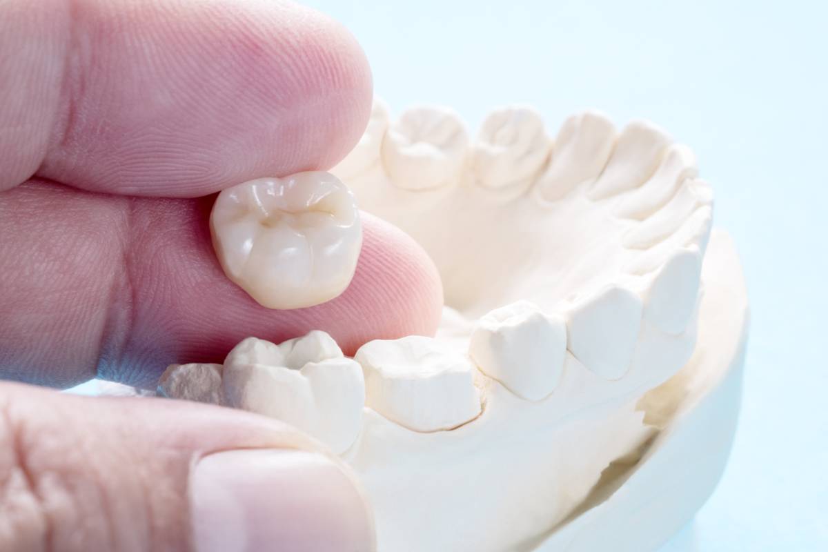 concept of dental crowns lifespan and maintenance