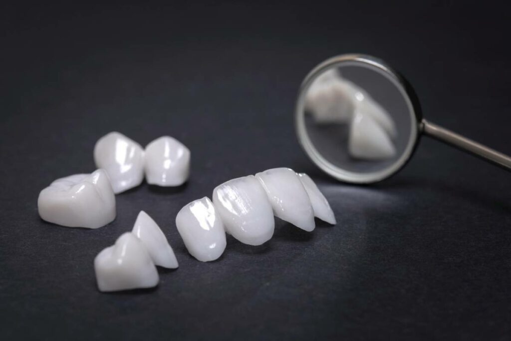 why-does-my-dental-bridge-keep-falling-out-pearl-dental-care