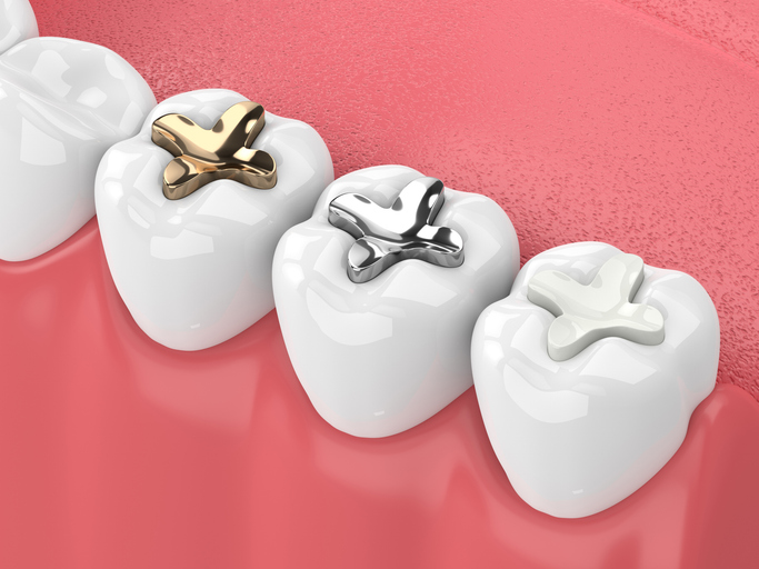 Featured image for Which Type of Dental Filling Is Right For You