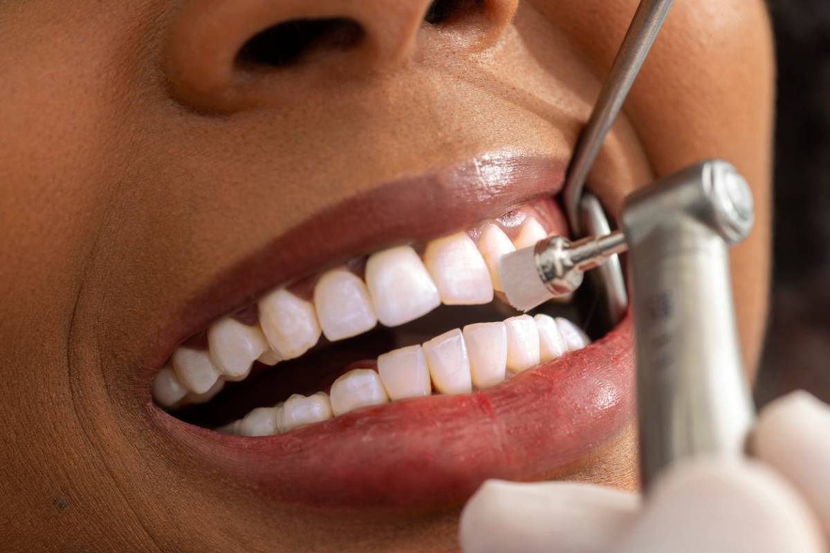 featured image for can you remove tartar from your teeth without a dentist