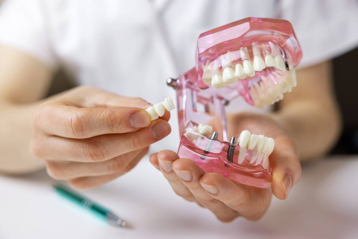 Featured image for How Long Does a Dental Bridge Last?